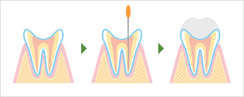 root-canal_11